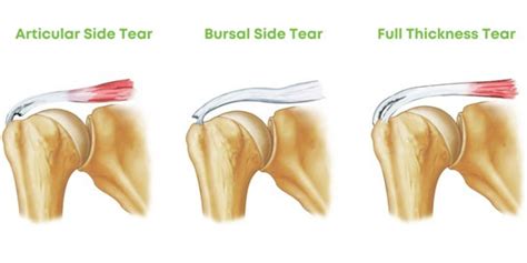 tests for supraspinatus tear|full thickness tear supraspinatus image.